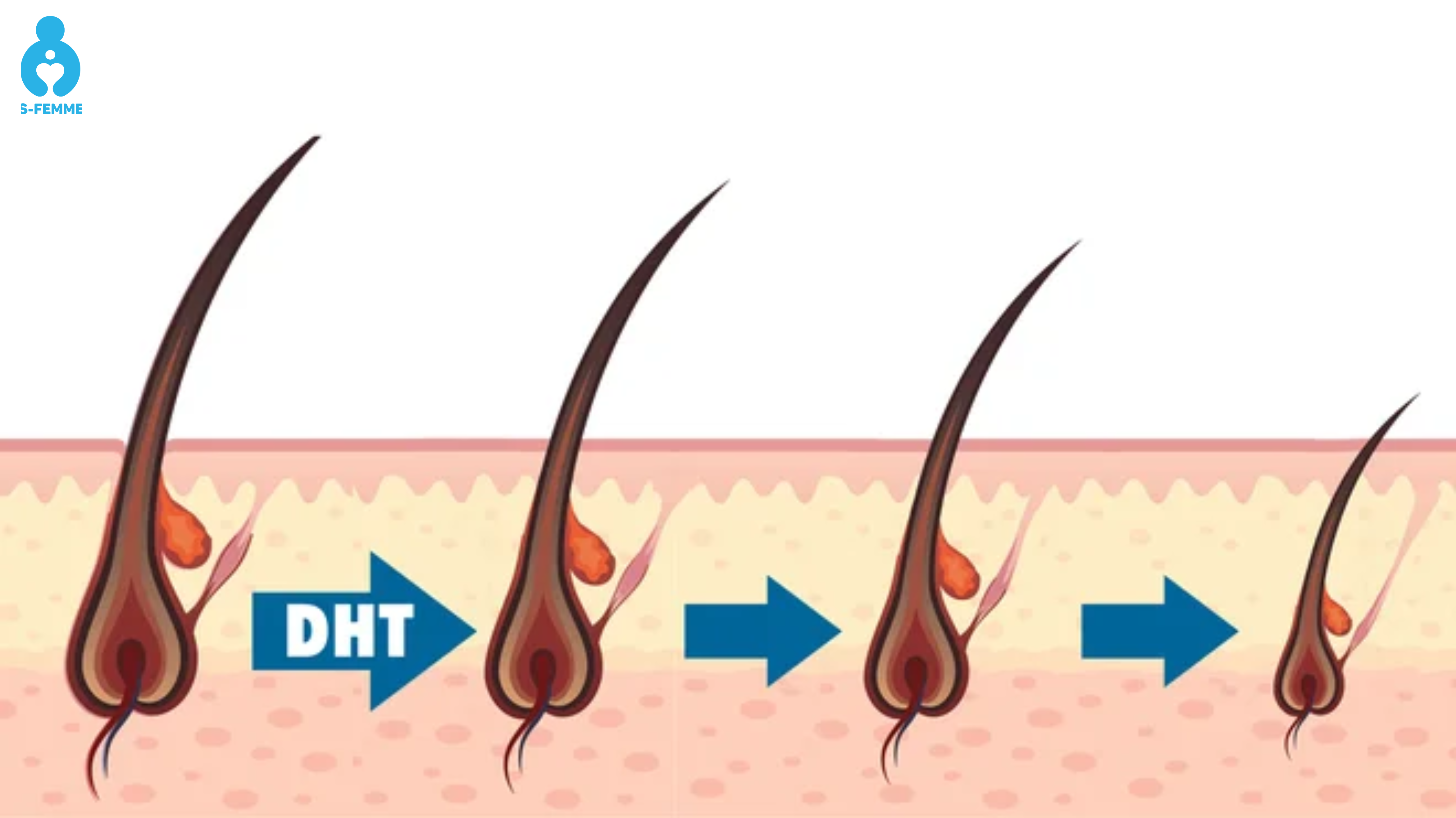 Dấu hiệu nhận biết rụng tóc do rối loạn testosterone