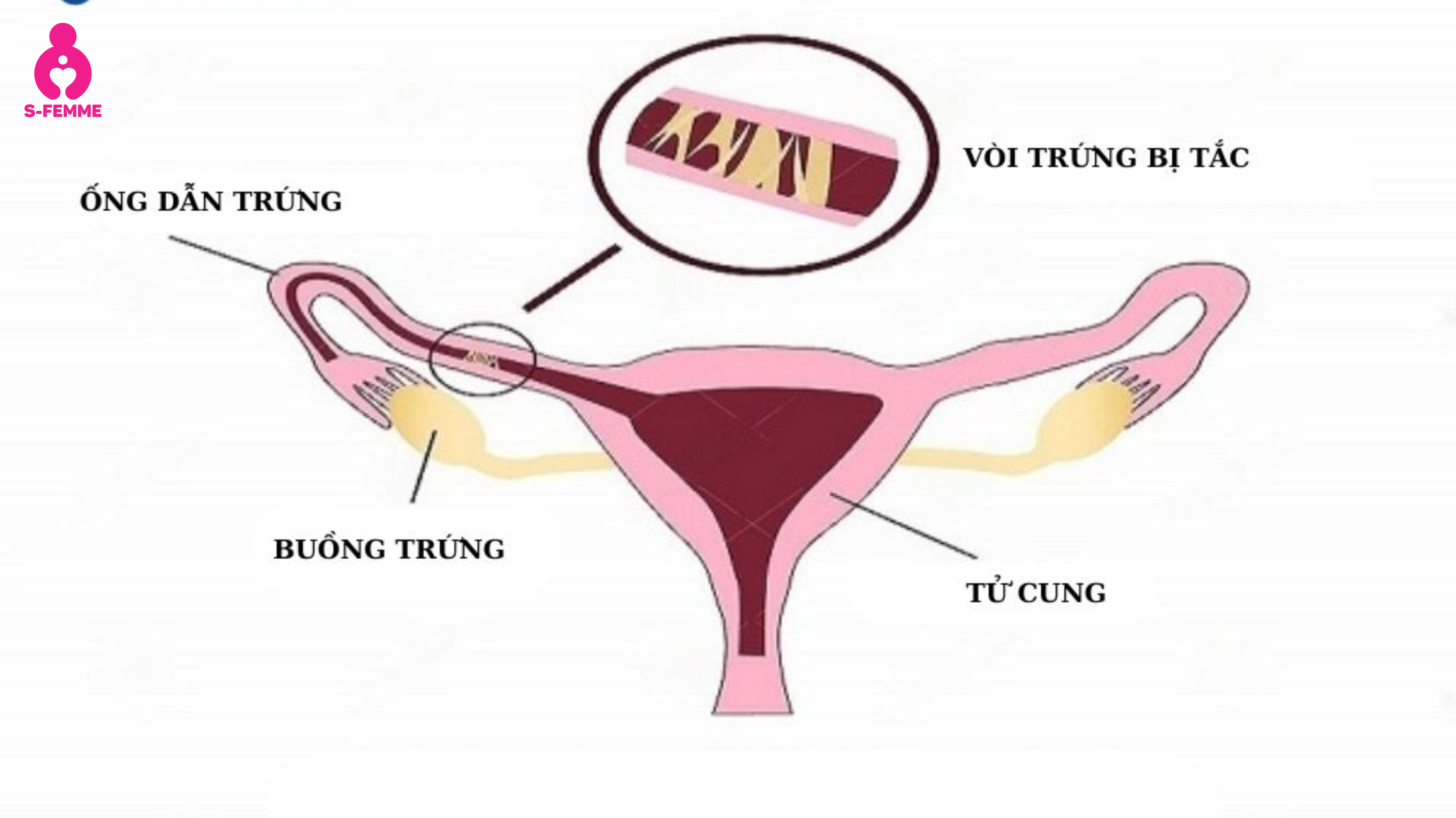 Nguyên-nhân-tắc-vòi -trứng