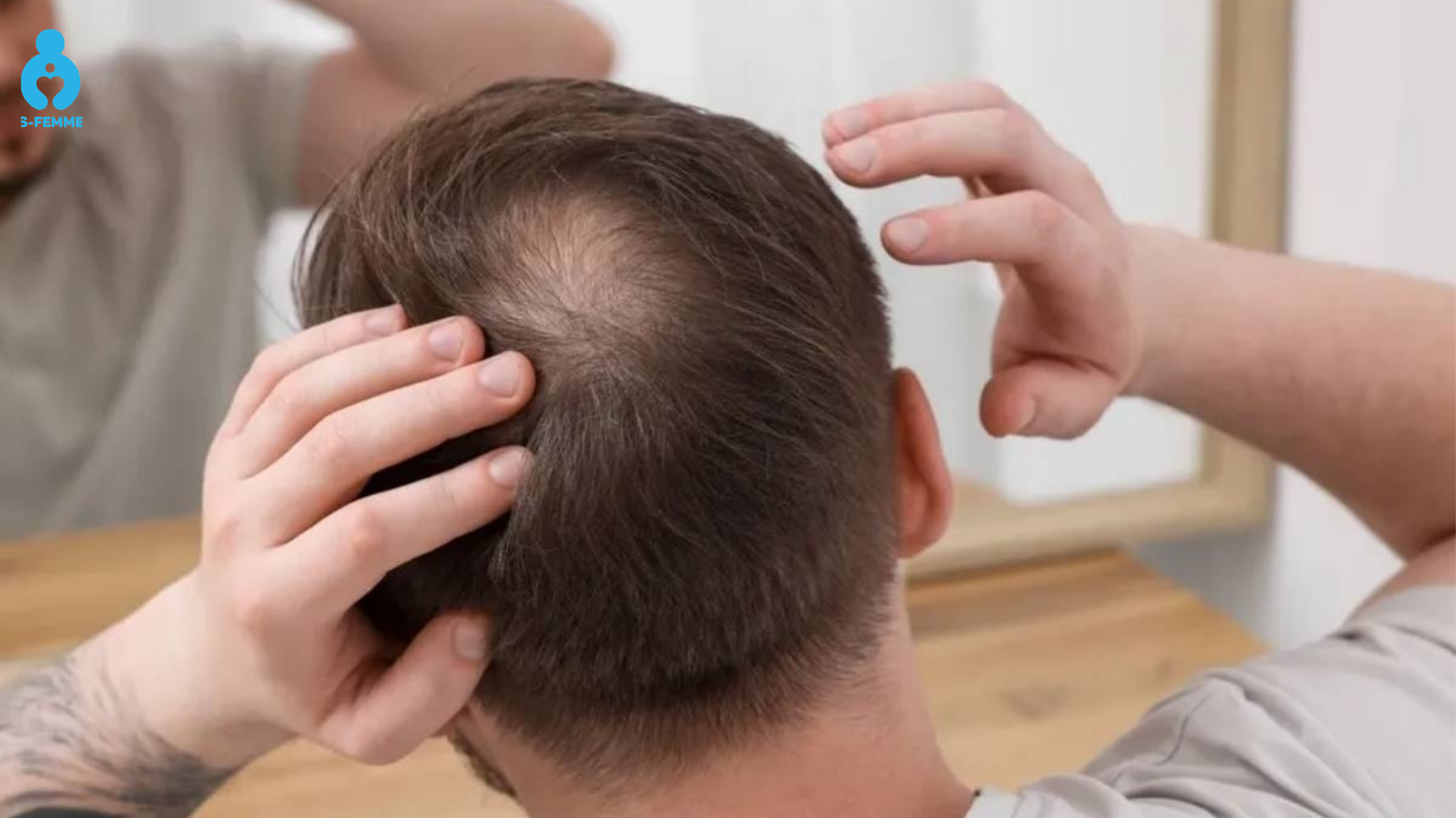 Tóc thưa dần vùng trán và đỉnh đầu ở nam giới