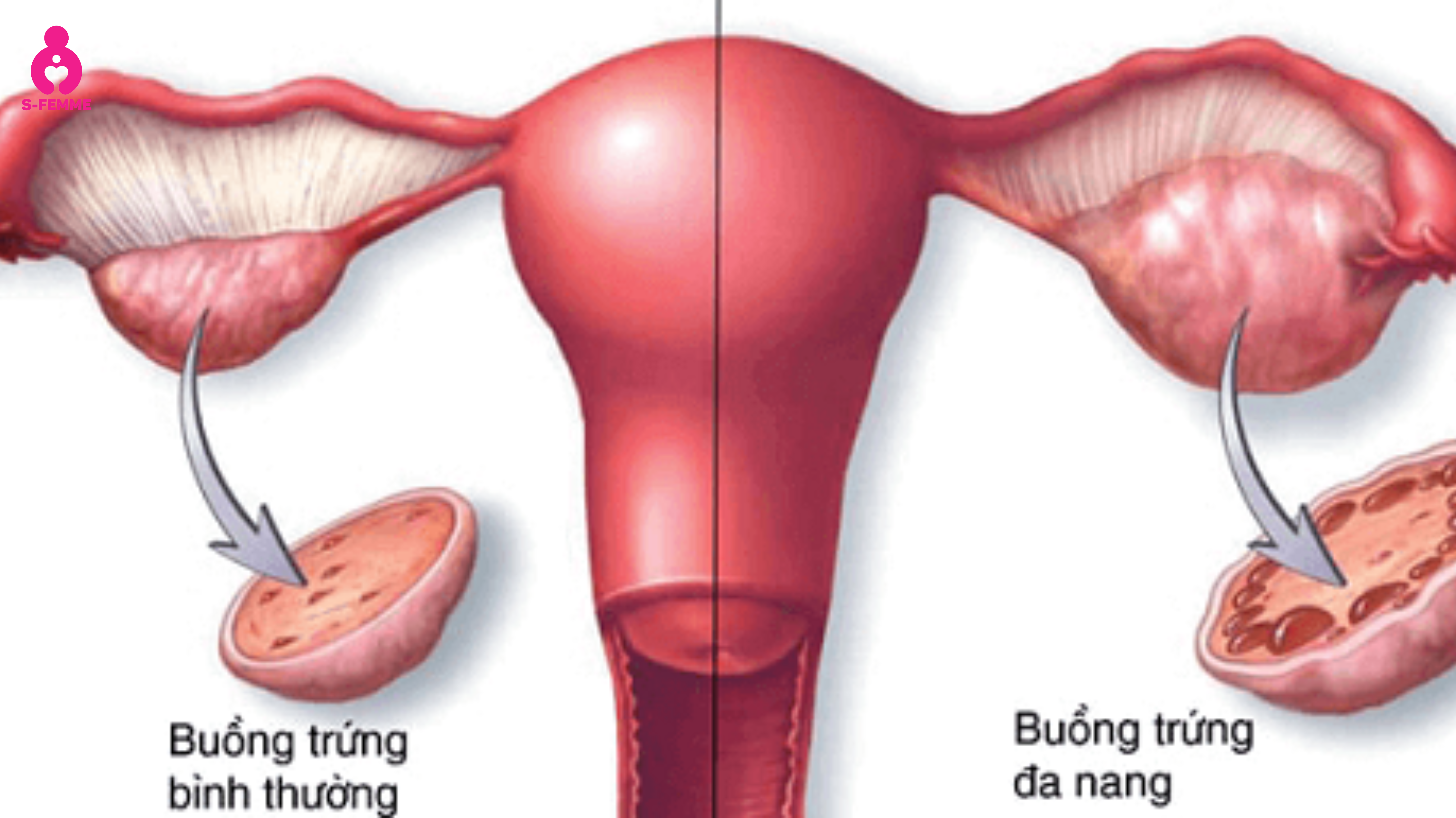 Tổng quan về hội chứng buồng trứng đa nang (PCOS)
