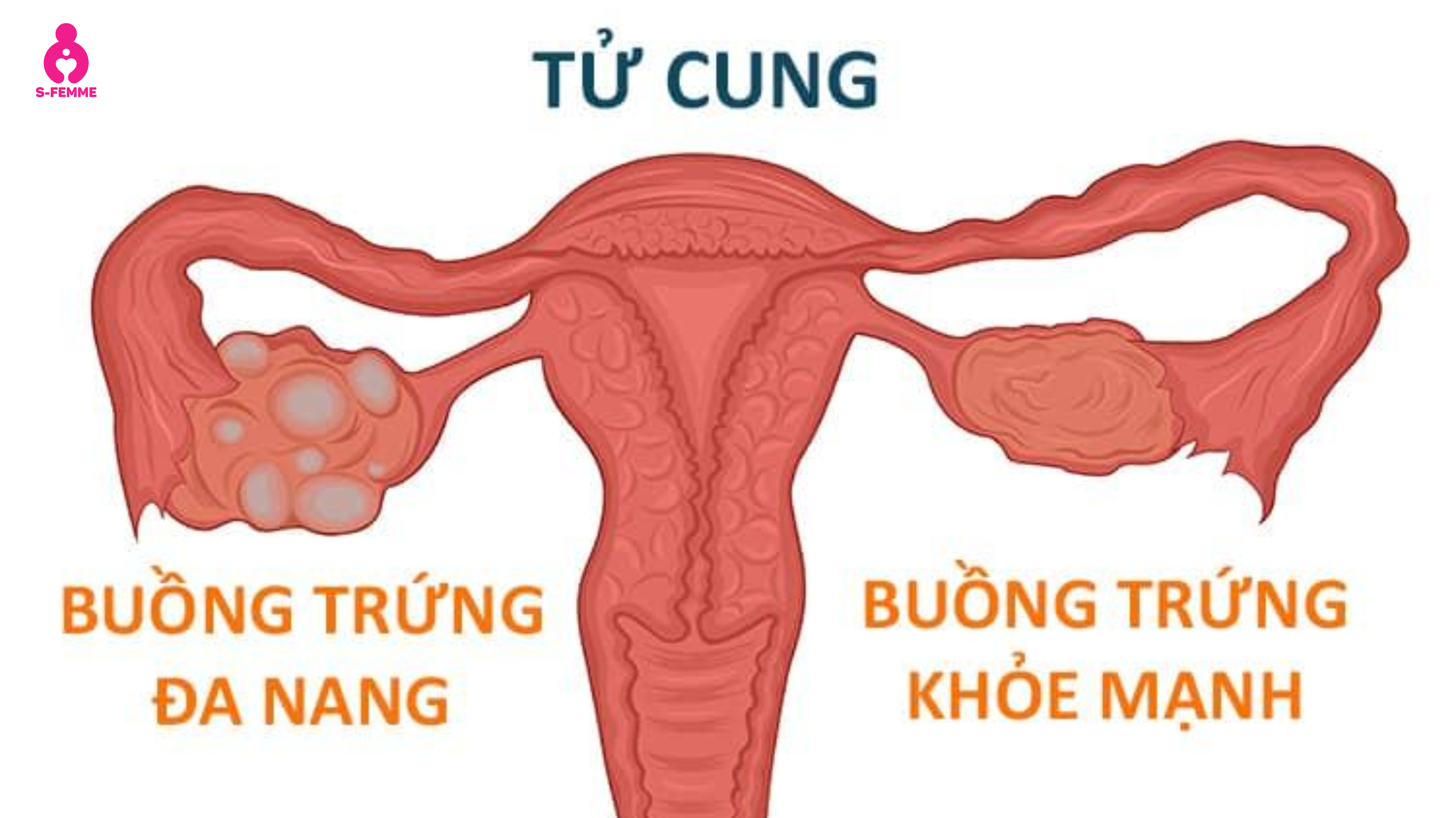 a nang buồng trứng là gì