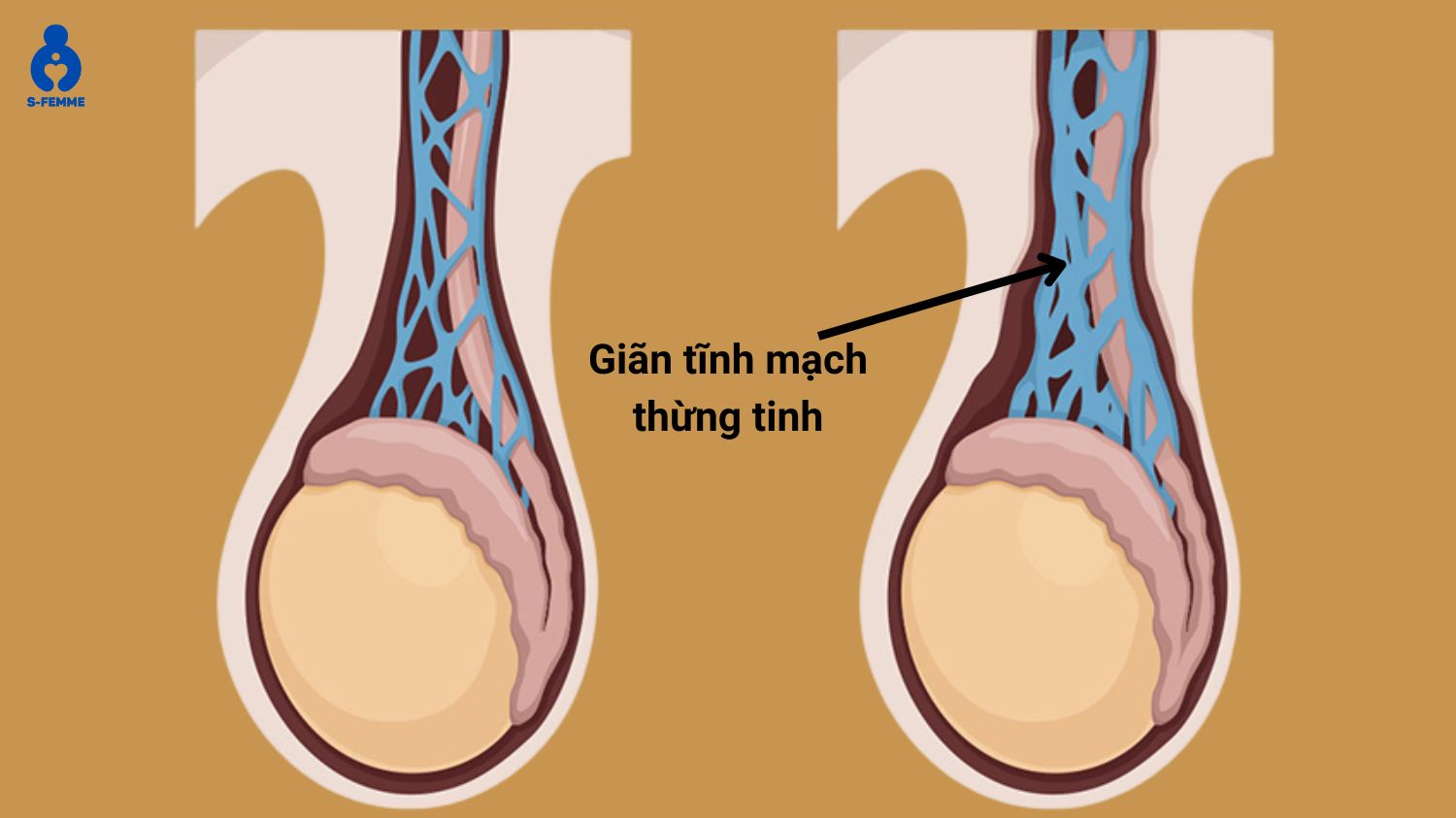 Bệnh hiếm muộn ở nam có thể do giãn tĩnh mạch thừng tinh