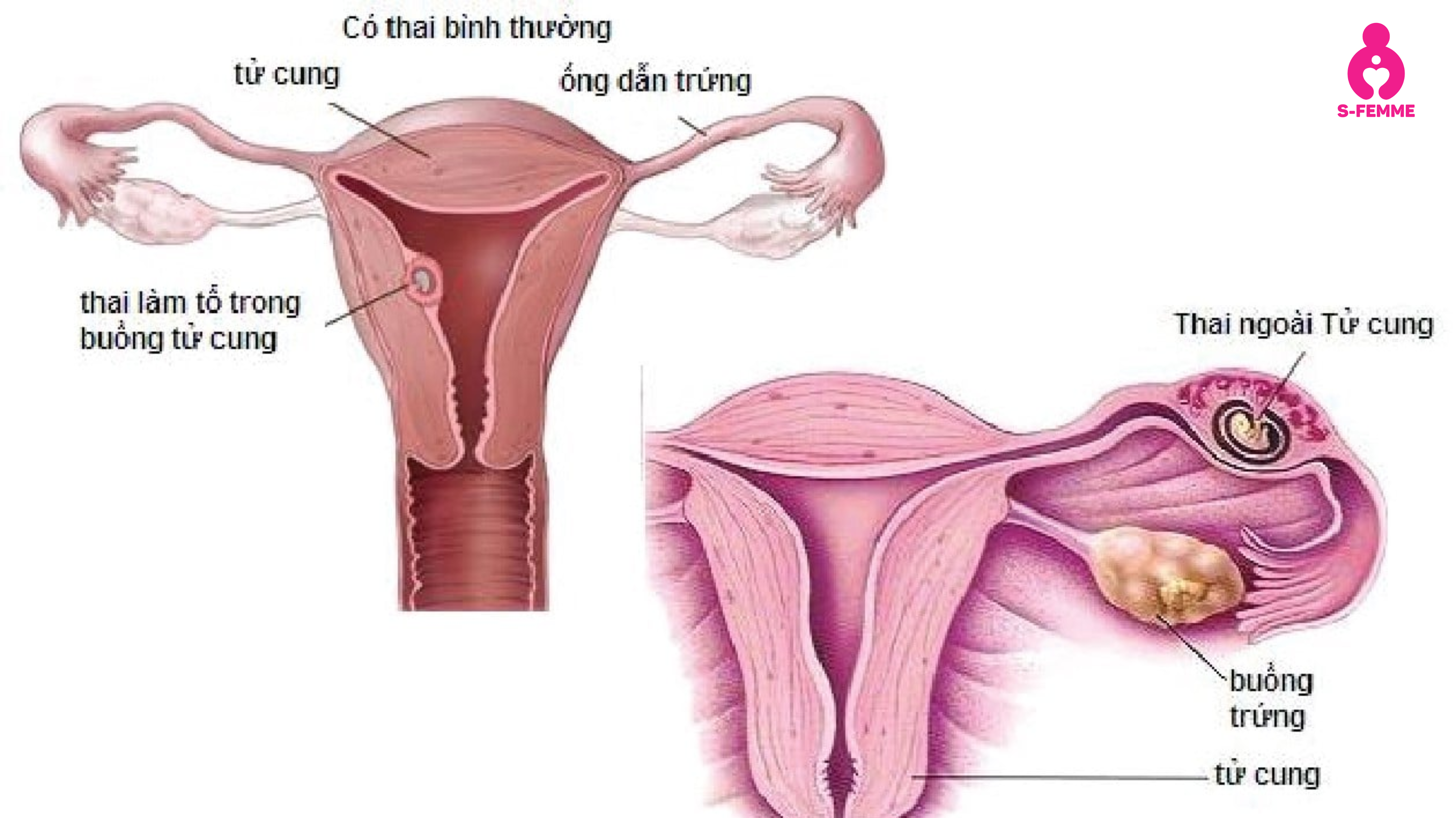 dấu-hiệu-tắc-vòi-trứng