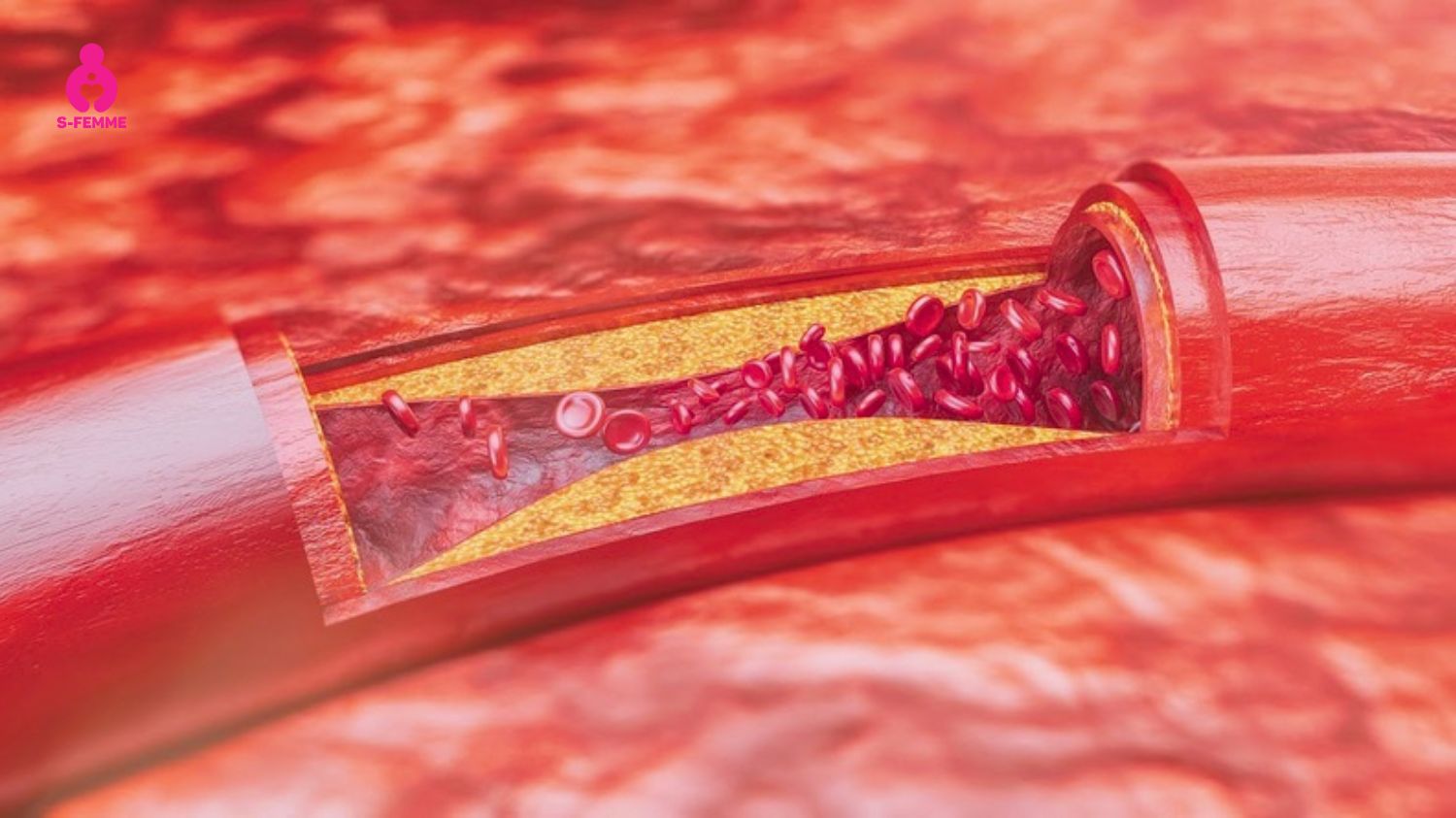 Kháng Insulin là nguyên nhân phổ biến gây đa nang buồng trứng