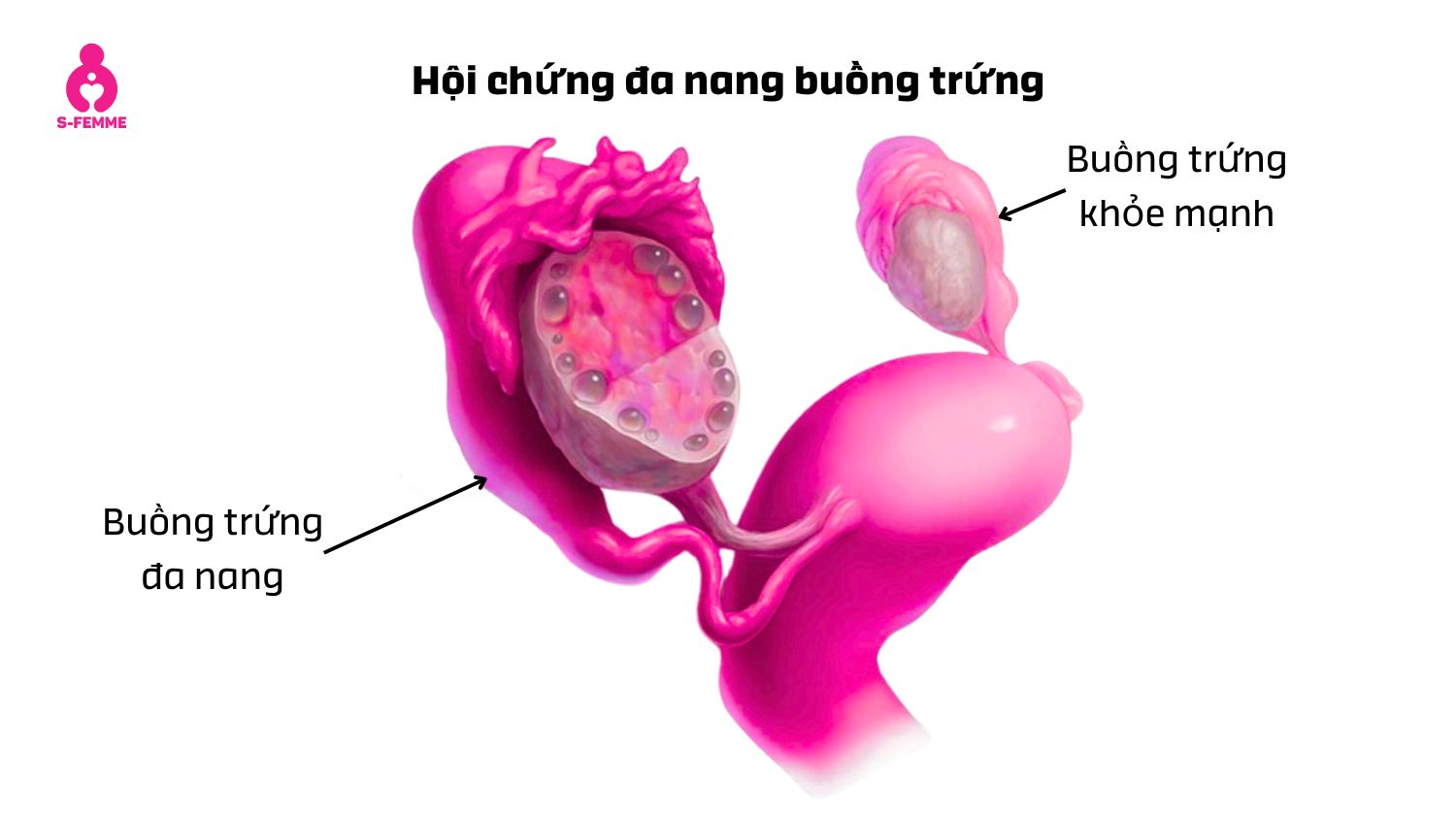 Phụ nữ bị buồng trứng đa nang dễ mắc phải quá kích buồng trứng