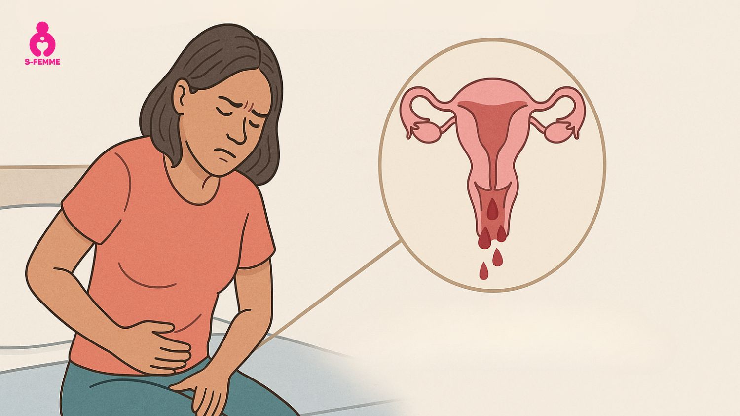 Triệu chứng của quá sản niêm mạc tử cung điển hình là ra máu âm đạo