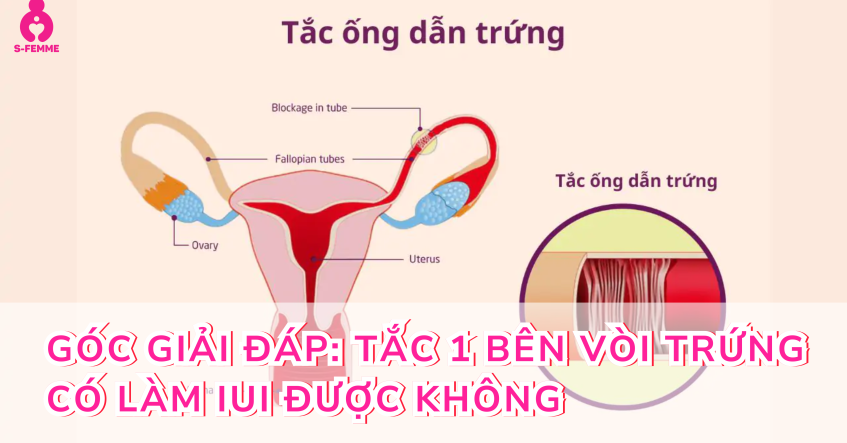 Góc giải đáp: Tắc 1 bên vòi trứng có làm iui được không