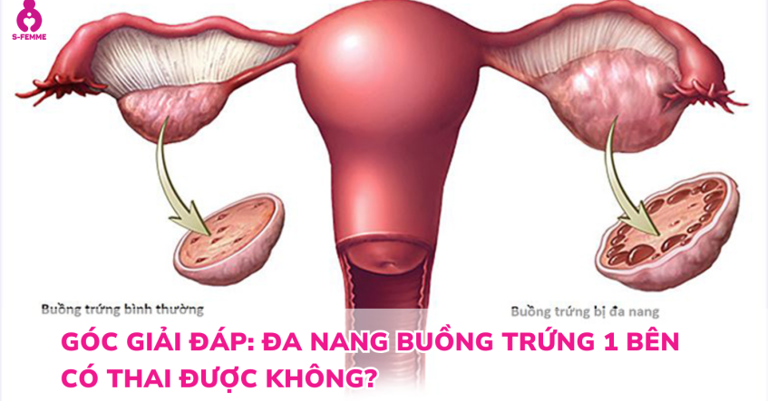 Góc giải đáp: Đa nang buồng trứng 1 bên có thai được không?