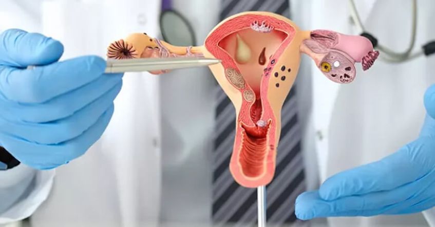 Nhiều người không biết mình mắc đa nang buồng trứng