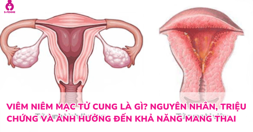 Viêm niêm mạc tử cung là gì? Nguyên nhân, triệu chứng và ảnh hưởng đến khả năng mang thai