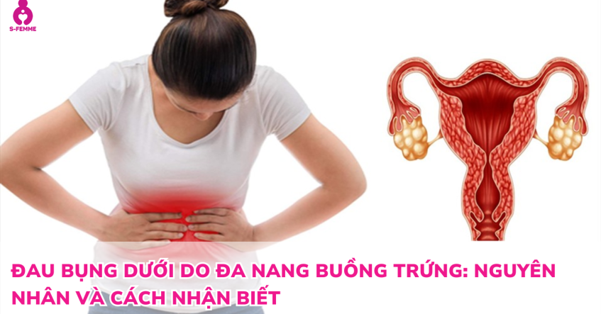 Đau bụng dưới do đa nang buồng trứng: Nguyên nhân và cách nhận biết
