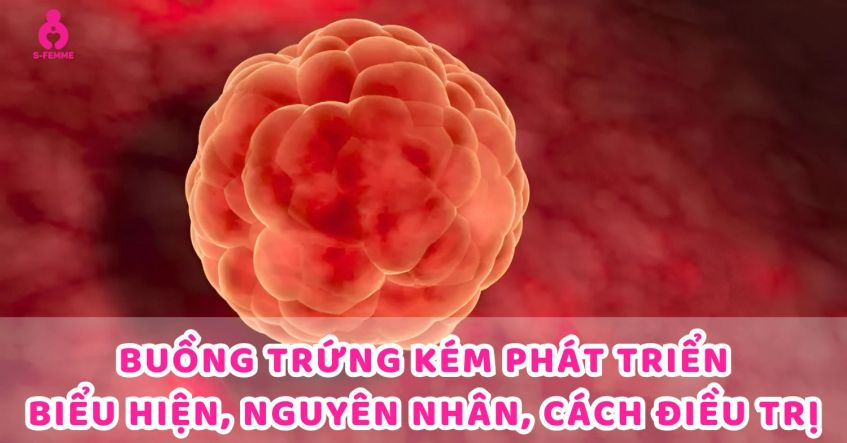 Buồng trứng kém phát triển​ | Biểu hiện, Nguyên nhân, Cách điều trị