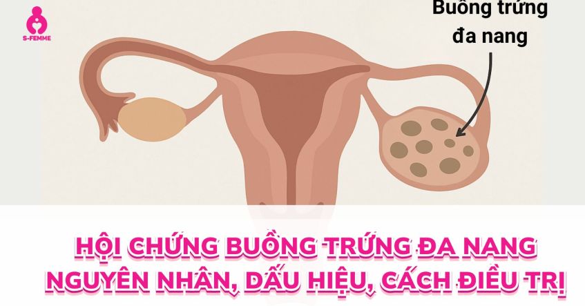 Hội chứng buồng trứng đa nang (PCOS) | Nguyên nhân, Dấu hiệu, Cách điều trị