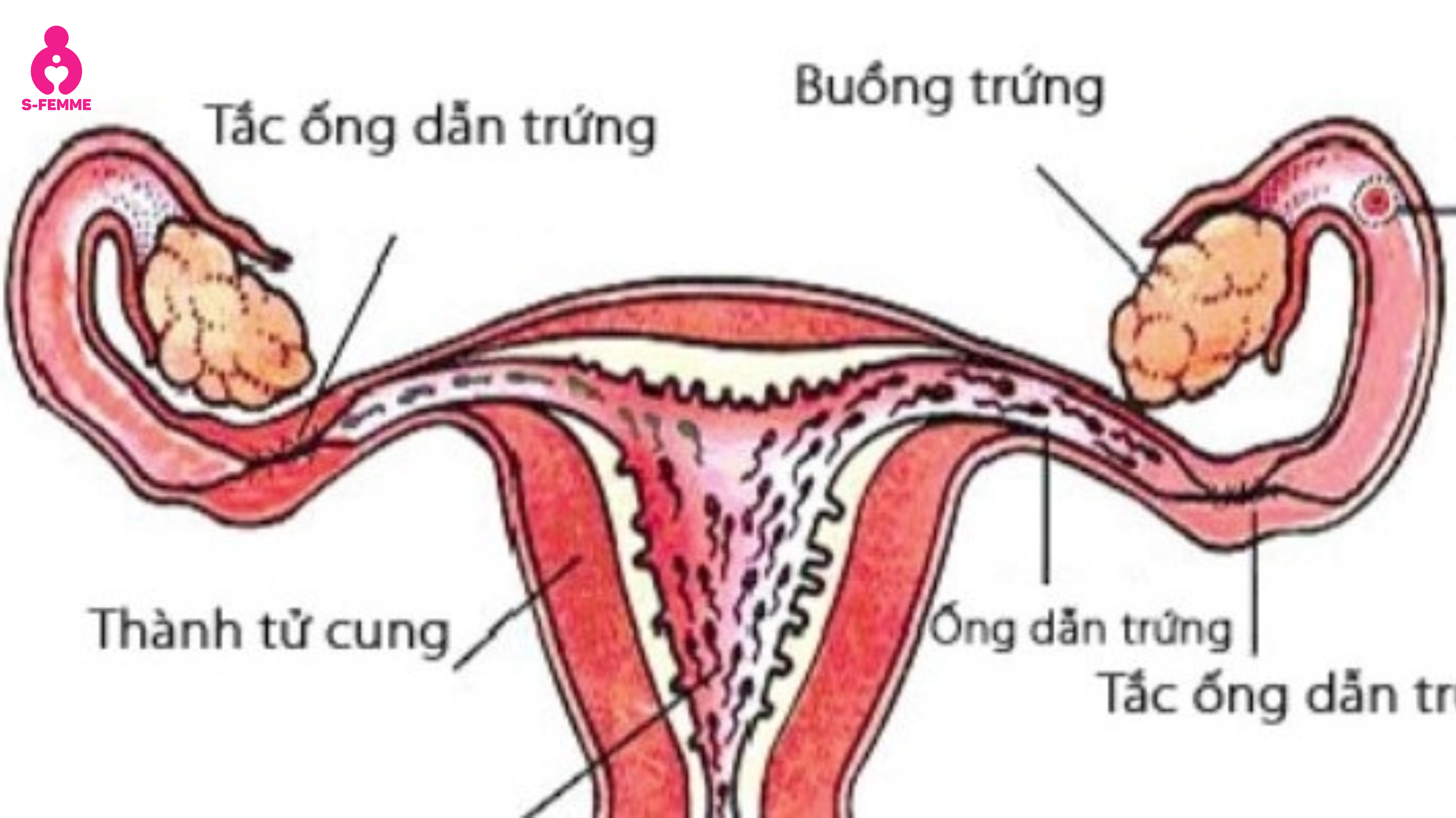 tắc ống dẫn trứng có thai được không 1