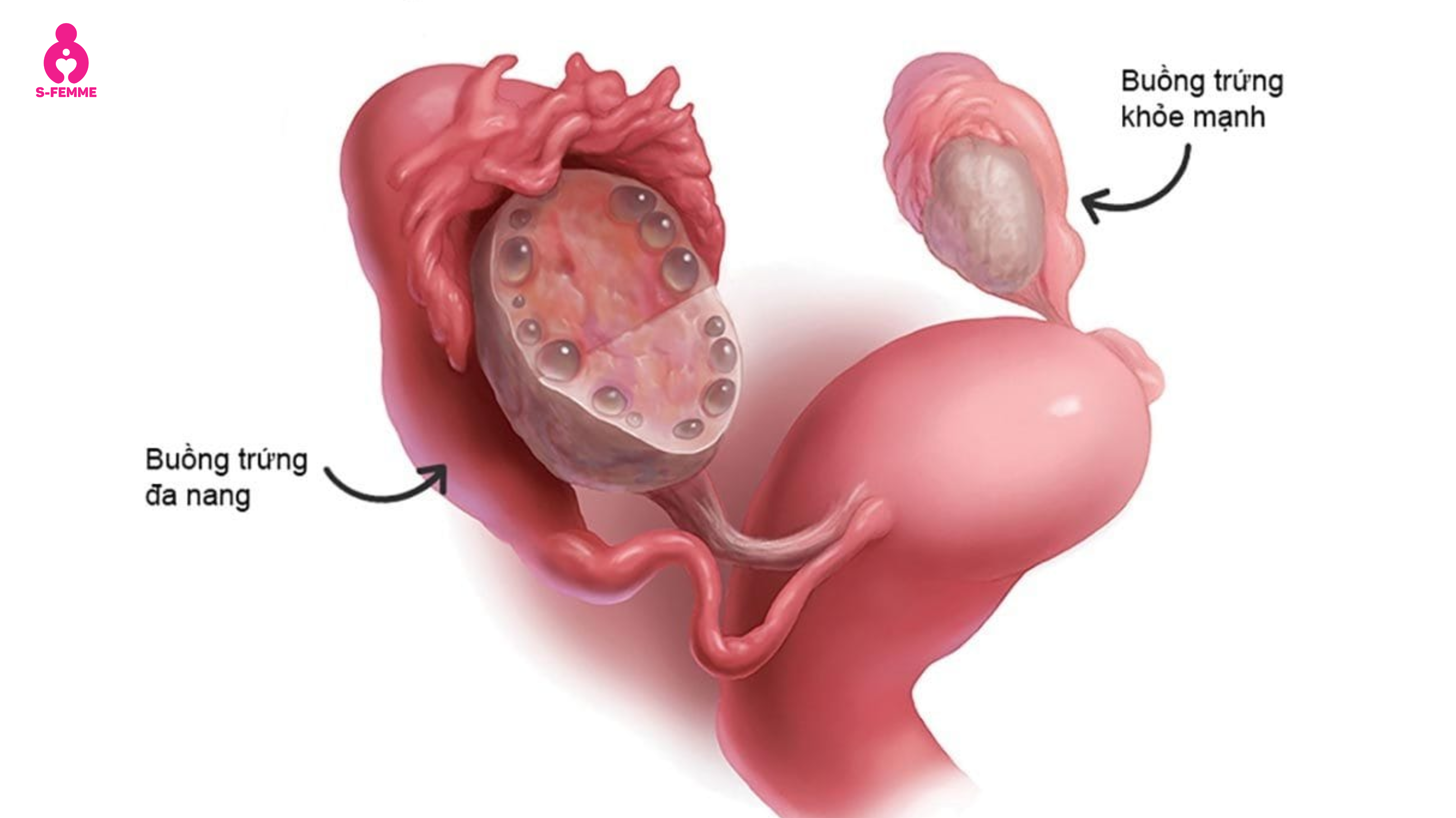 Hội chứng buồng trứng đa nang ở người gầy là gì