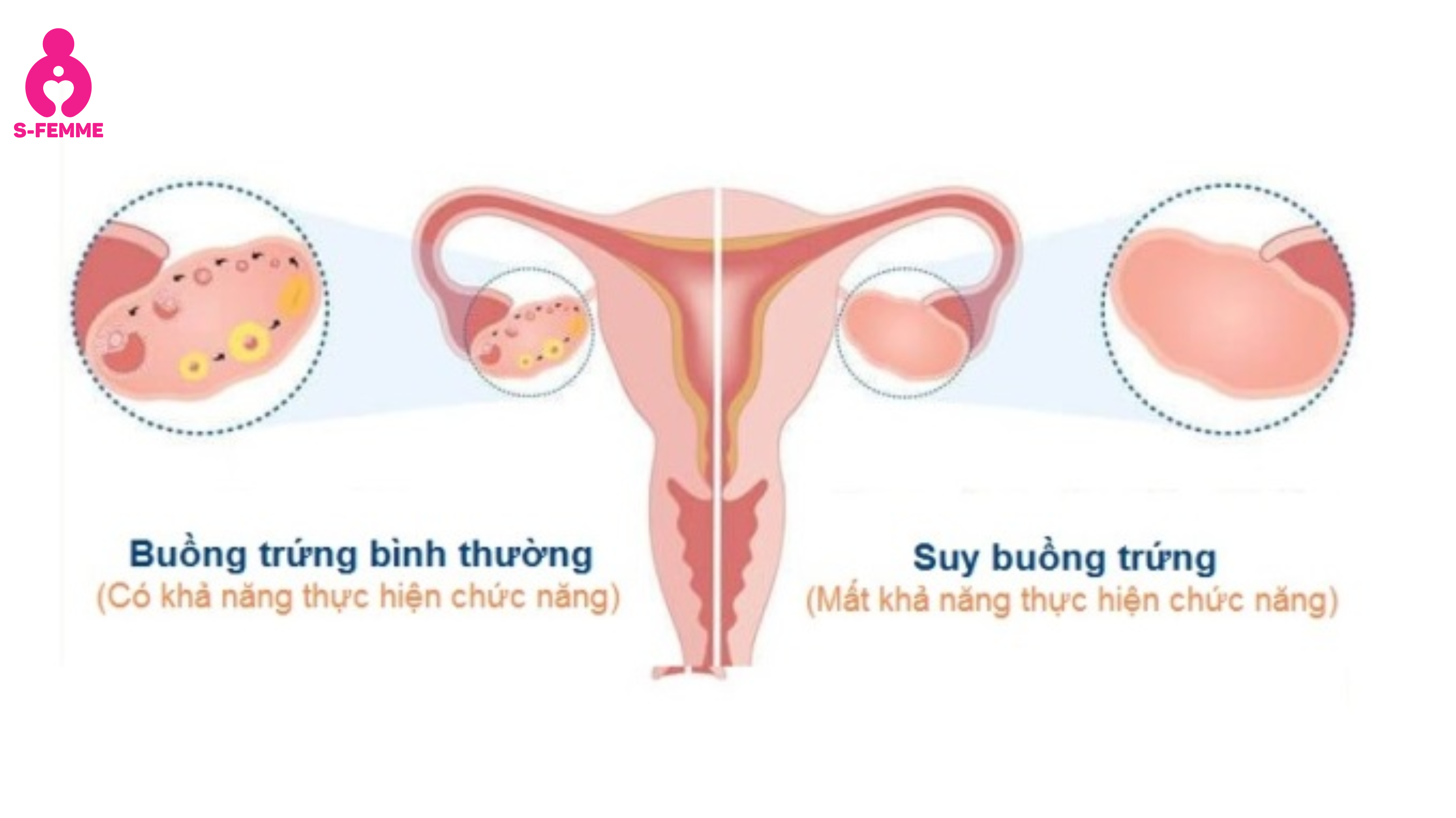 Nguyên nhân gây niêm mạc tử cung mỏng