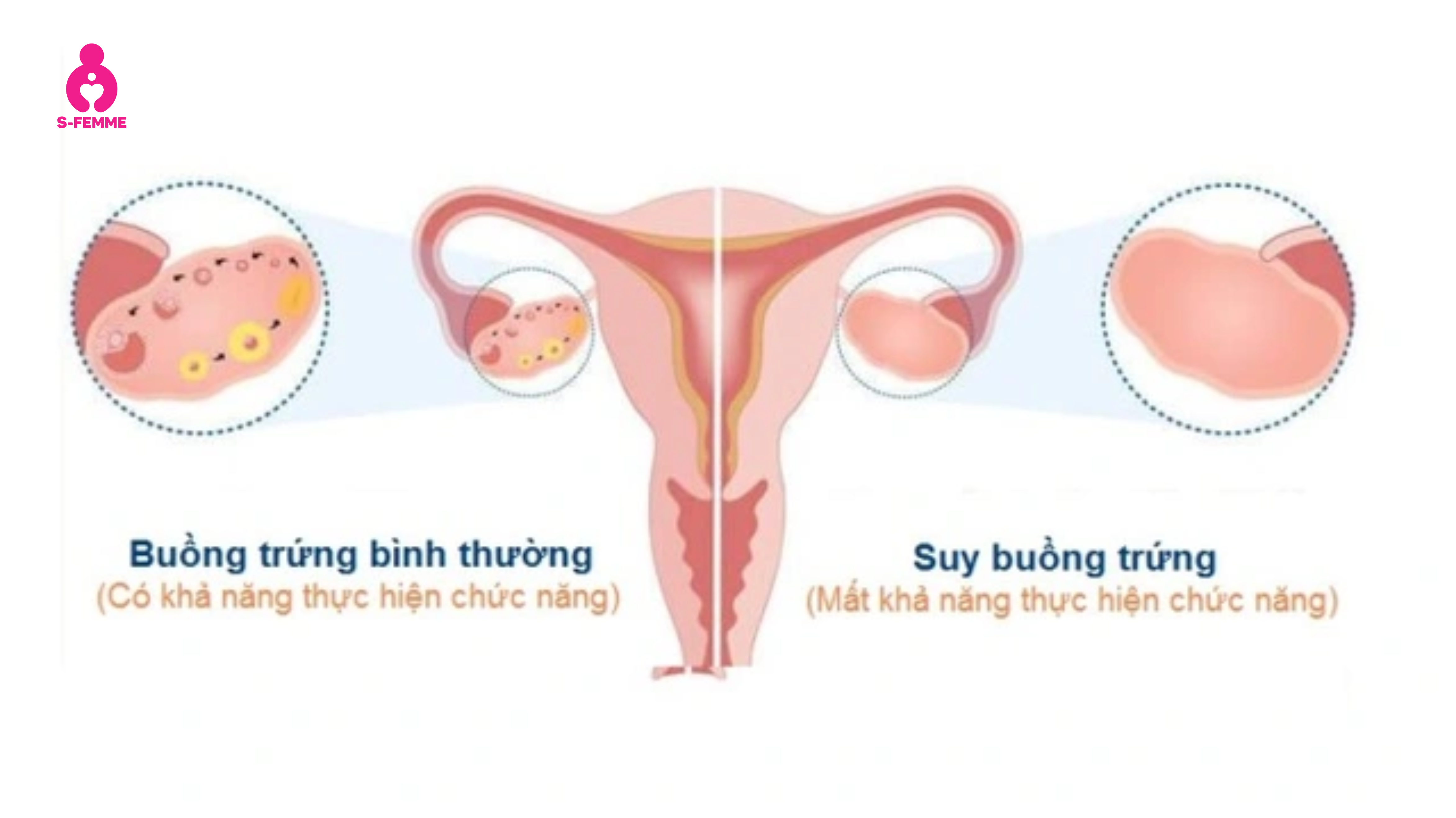 Suy buồng trứng là gì