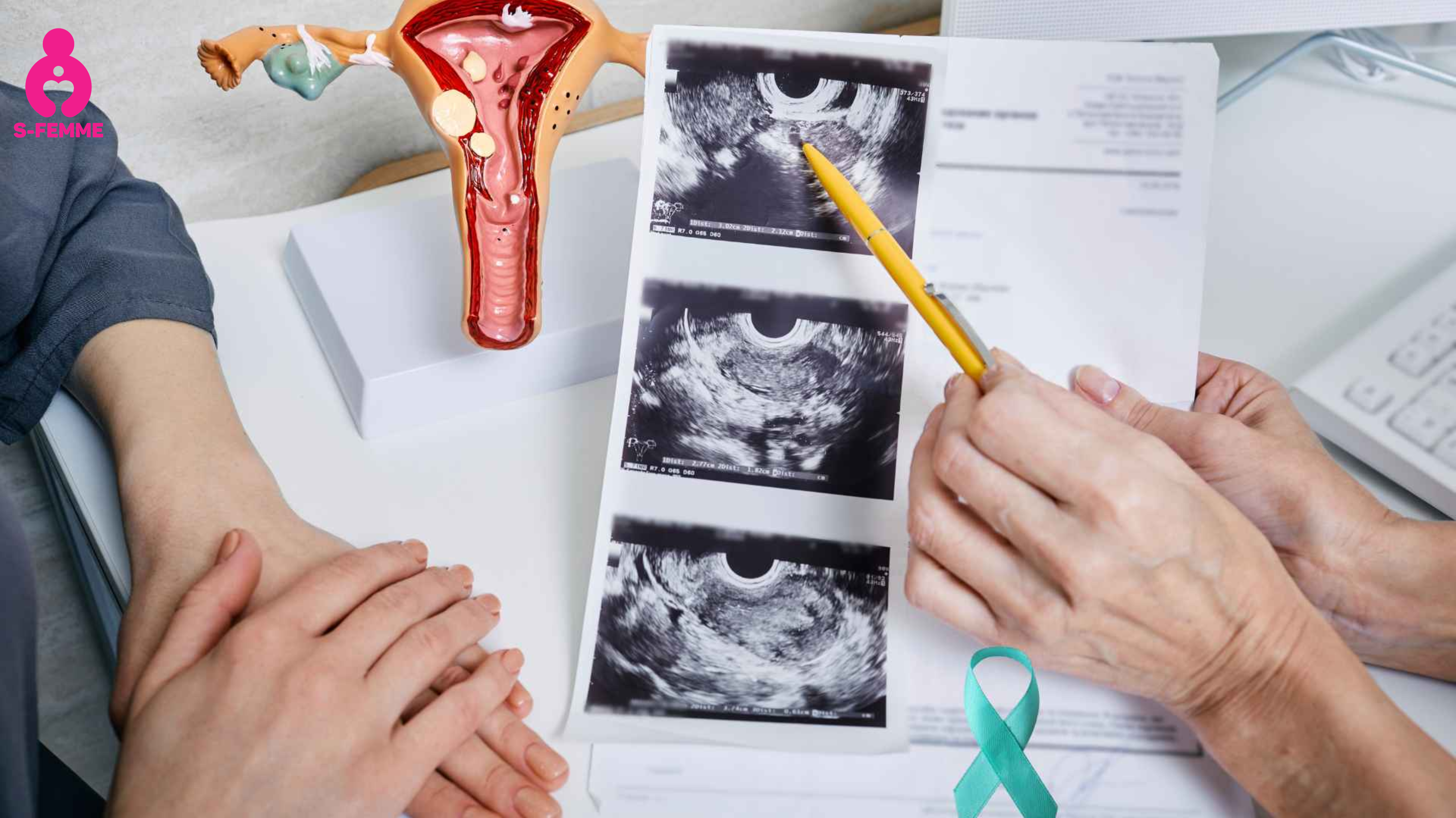 Triệu chứng PCOS ở người gầy_1