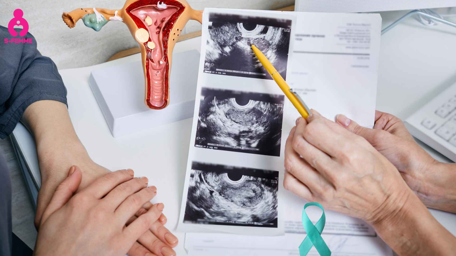 Vì sao đa nang buồng trứng có thể gây đau bụng dưới