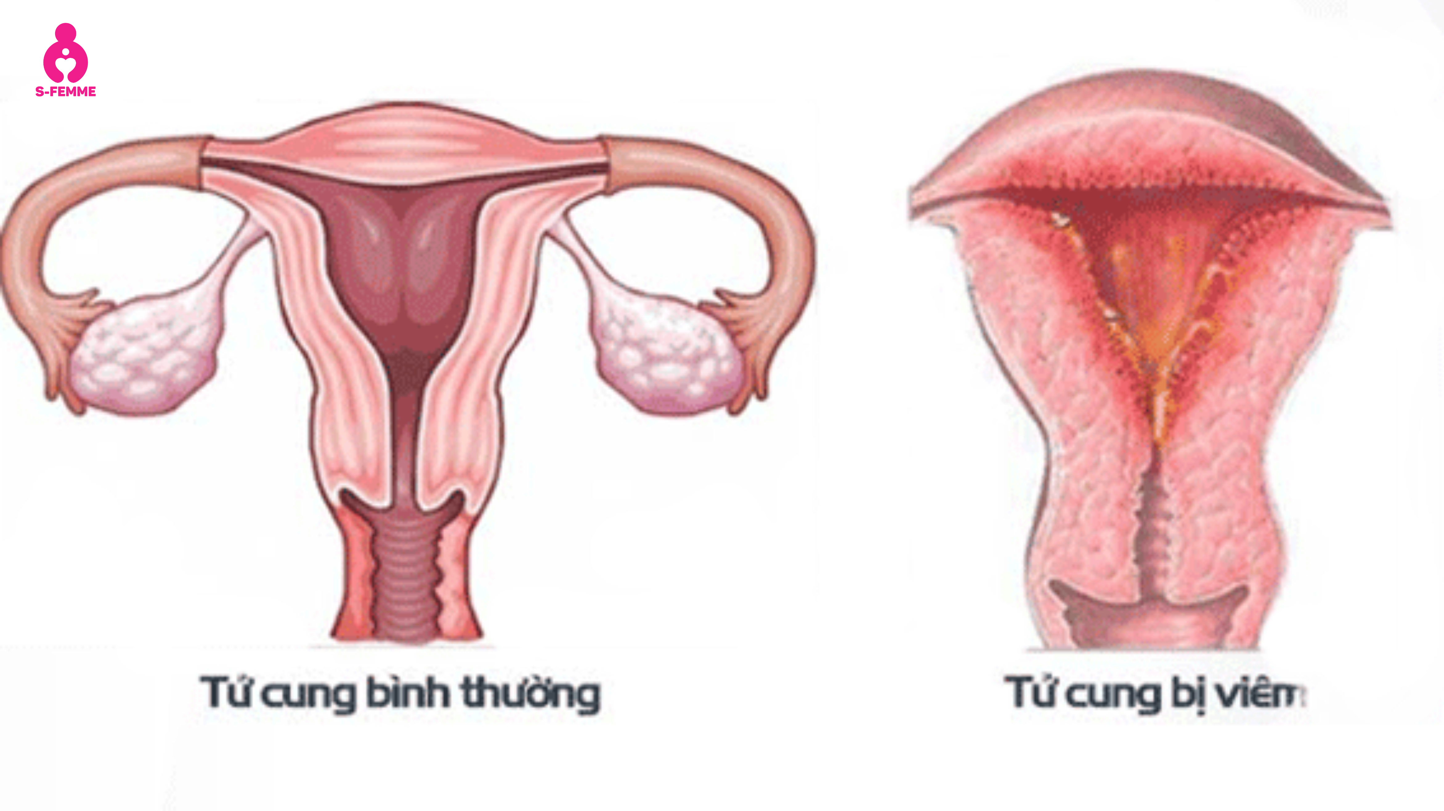 Viêm niêm mạc tử cung là gì